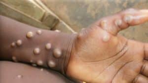 Nigeria Records 40 Cases Of Mpox