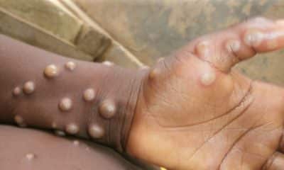 Africa Didn't Receive Mpox Vaccine - Ex-DG NCDC, Prof Nasidi